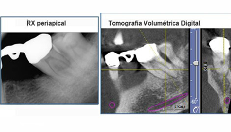 Tomografía Volumétrica Digital