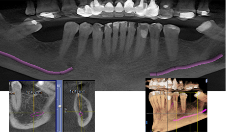 Tomografía Volumétrica Digital